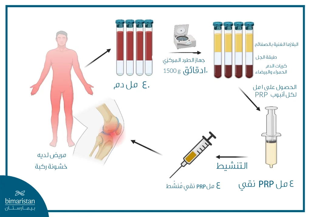 صورة توضح طريقة إجراء حقن الركبة