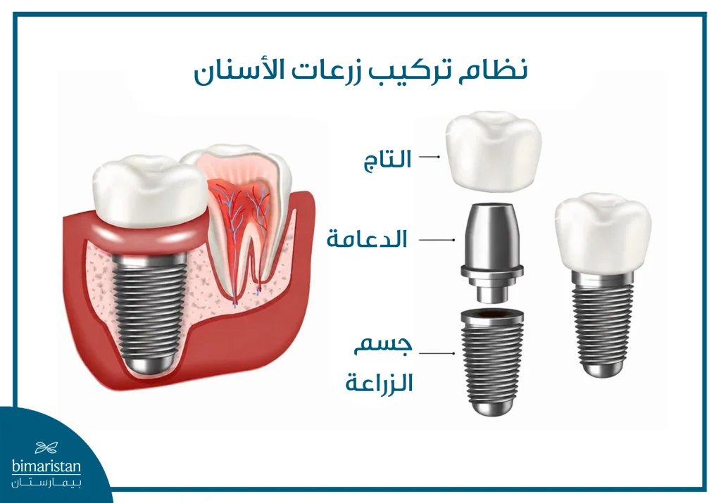 صورة توضيحية لنظام تركيب زرعات الأسنان