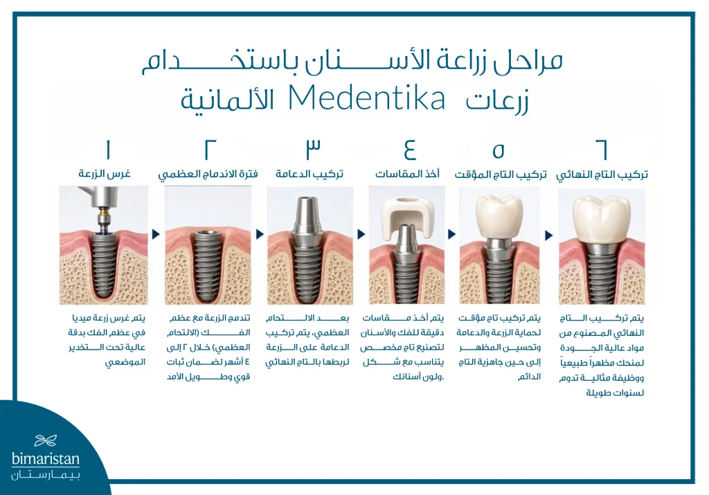 مراحل زراعة الأسنان باستخدام زرعات الالمانية