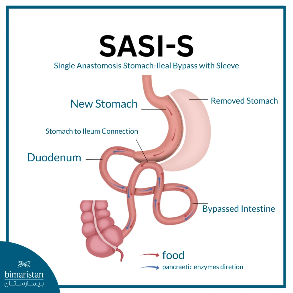 Single Anastomosis Stomach-Ileal Bypass With Sleeve