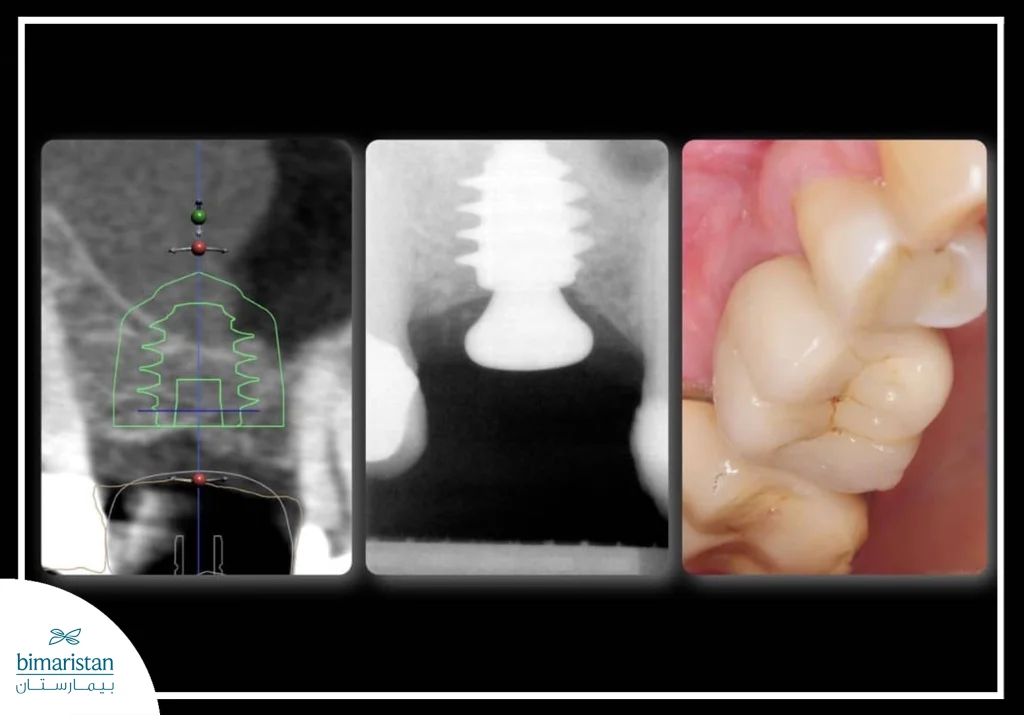 A Three-Part Image Illustrating The Stages Of Dental Implantation: It Begins With 3D Digital Planning To Determine The Implant'S Location, Followed By A Radiographic Image Showing Bone Fusion With The Implant In The Jaw, And Finally The Final Clinical Result Of The Artificial Tooth And Its Harmony With The Adjacent Teeth And Gums.