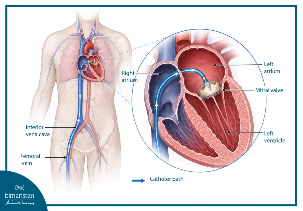 A Medical Illustration Showing The Catheter Path From The Femoral Vein Through The Inferior Vena Cava Toward The Heart And Mitral Valve.