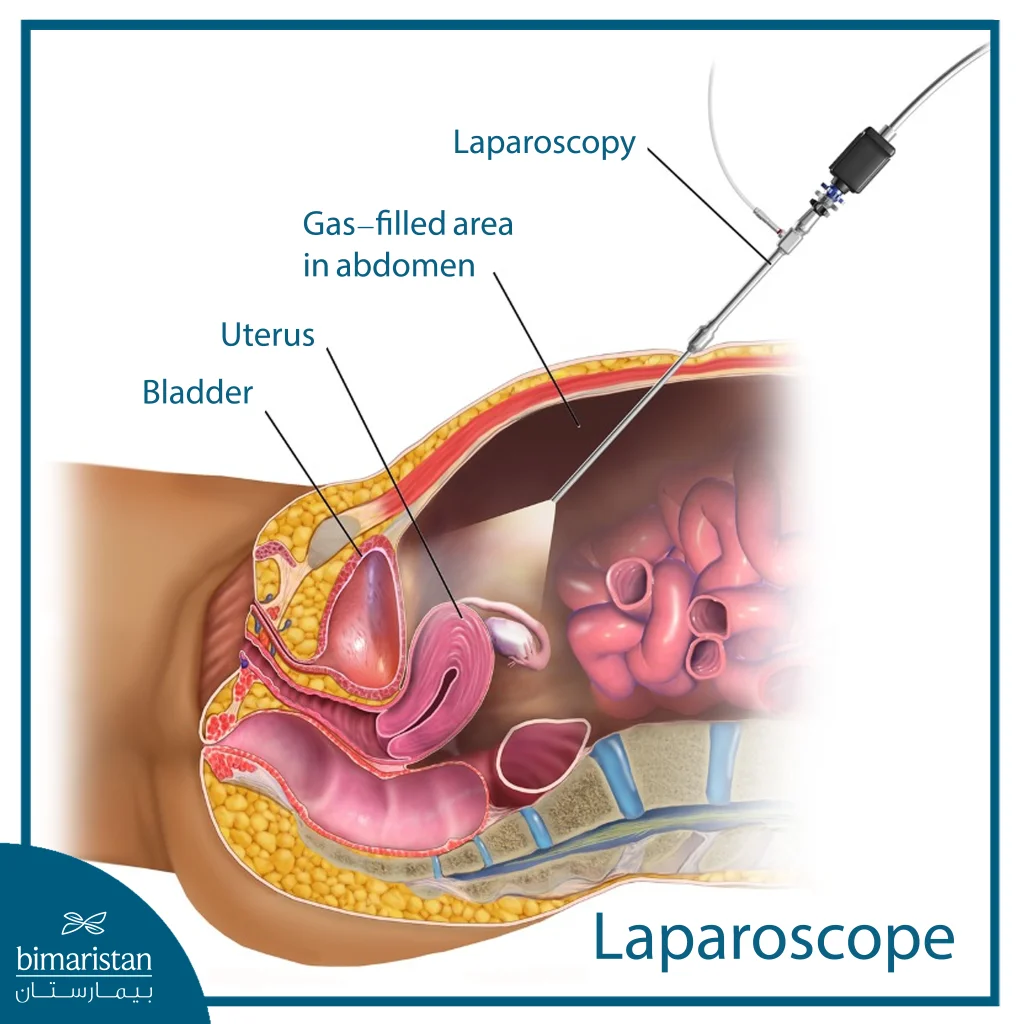 Anatomical Illustration Showing A Laparoscope Inserted Through The Abdominal Wall To View The Uterus And Bladder After The Abdomen Is Inflated With Gas.