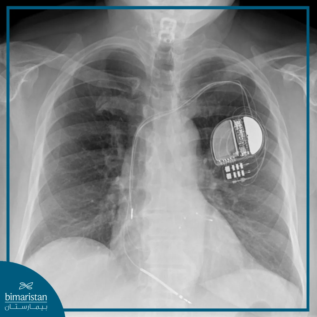 Chest X-Ray After Cardiac Resynchronization Therapy (Crt) Implantation Showing The Device Beneath The Collarbone And The Leads Positioned Inside The Heart