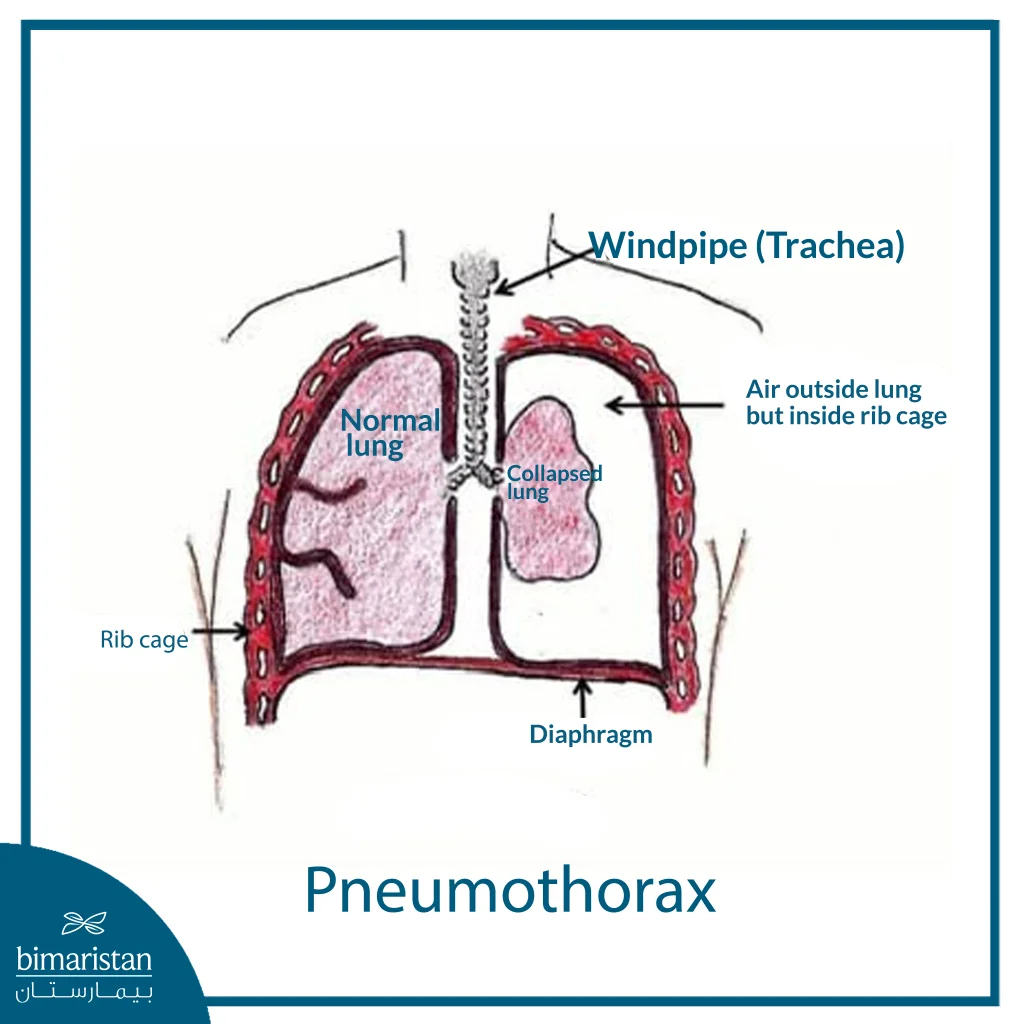 Diagram Of A Pneumothorax
