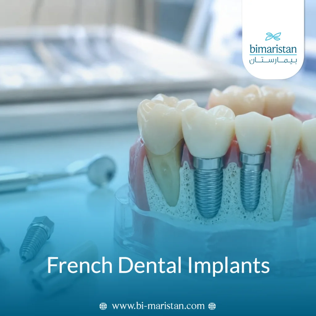 French Dental Implants: Features And Cost 4 French Dental Implants