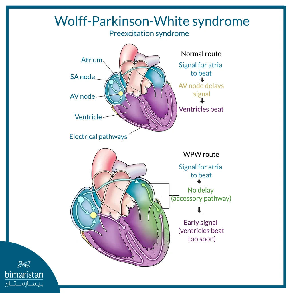 An Illustration Of Wolff-Parkinson-White Syndrome, Comparing The Normal Electrical Signal Pathway In The Heart With The Wpw Pathway, Which Allows The Signal To Pass Through An Additional Pathway Without Delay, Resulting In The Signal Reaching The Ventricles Earlier Than Normal