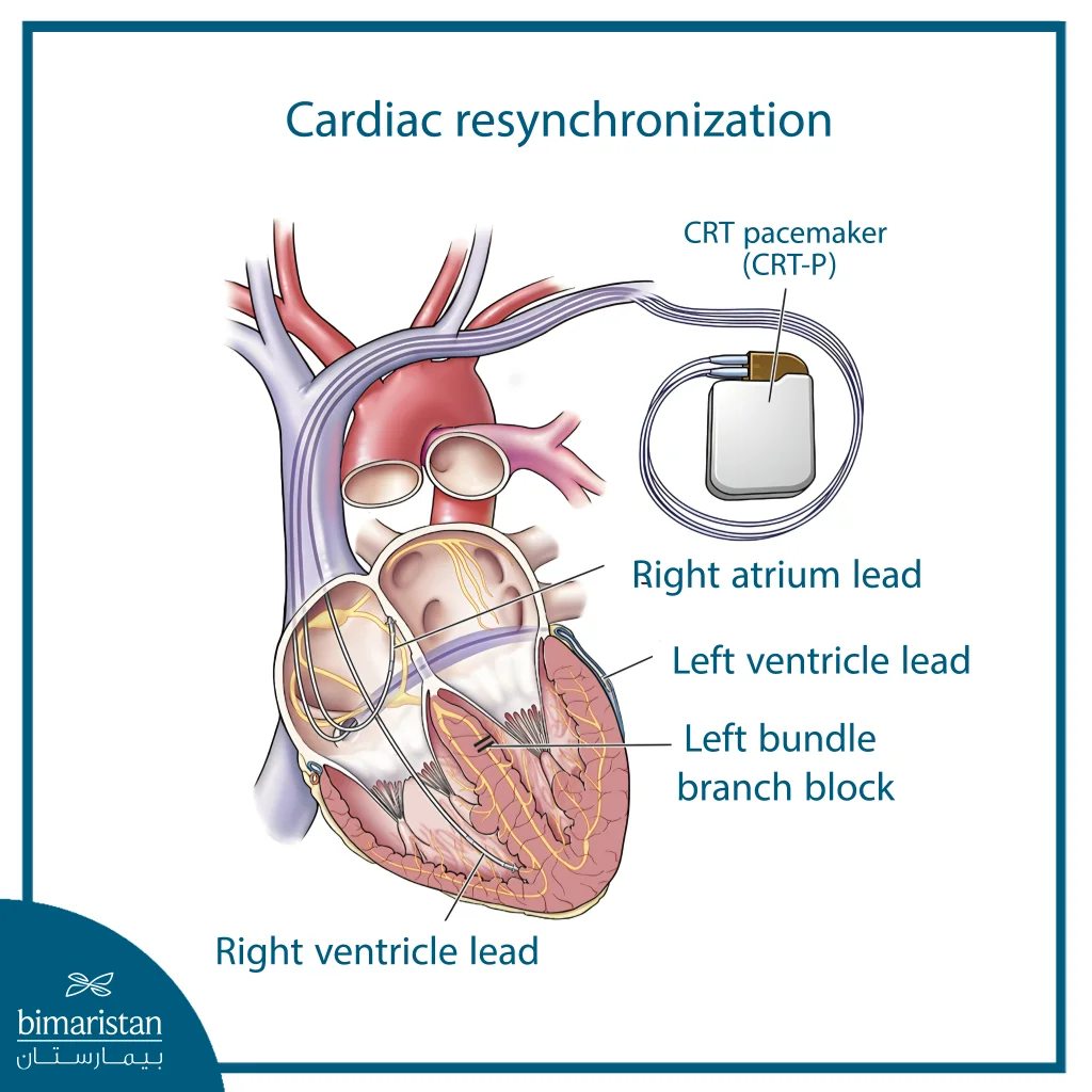 Illustration Of A Cardiac Resynchronization Therapy (Crt) Pacemaker Showing The Leads In The Right Atrium And Both Ventricles For Treating Left Bundle Branch Block