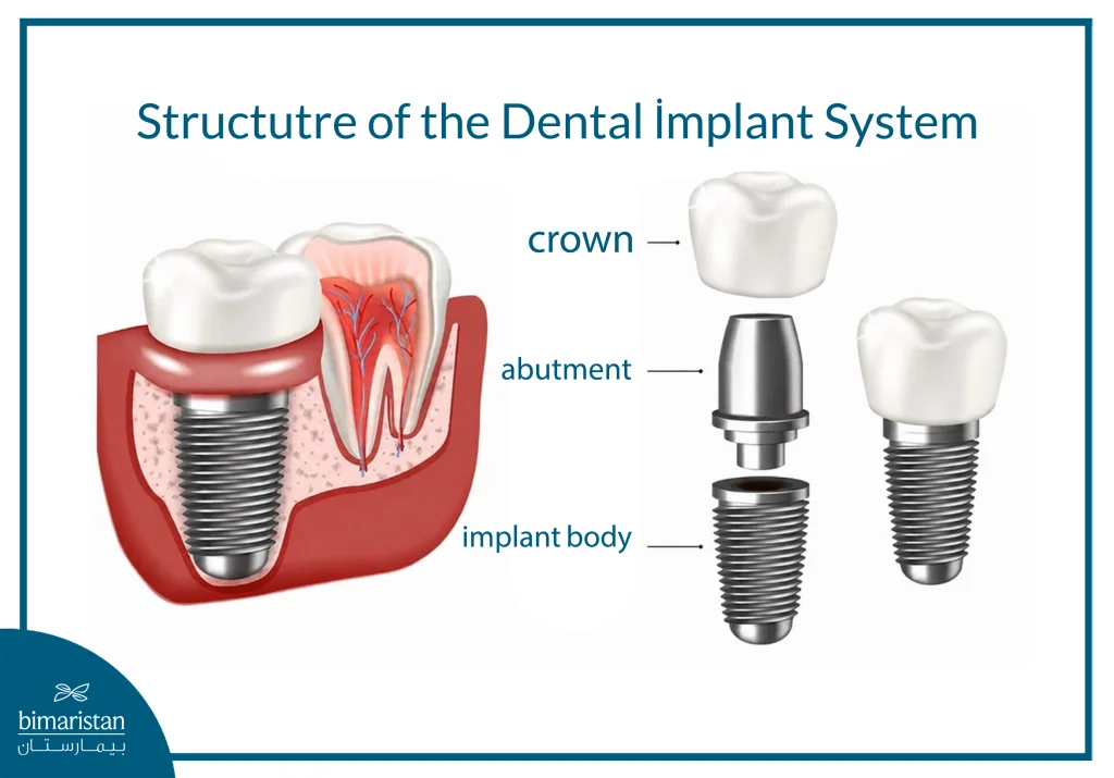 Illustration Showing The Components Of A Dental Implant Syst