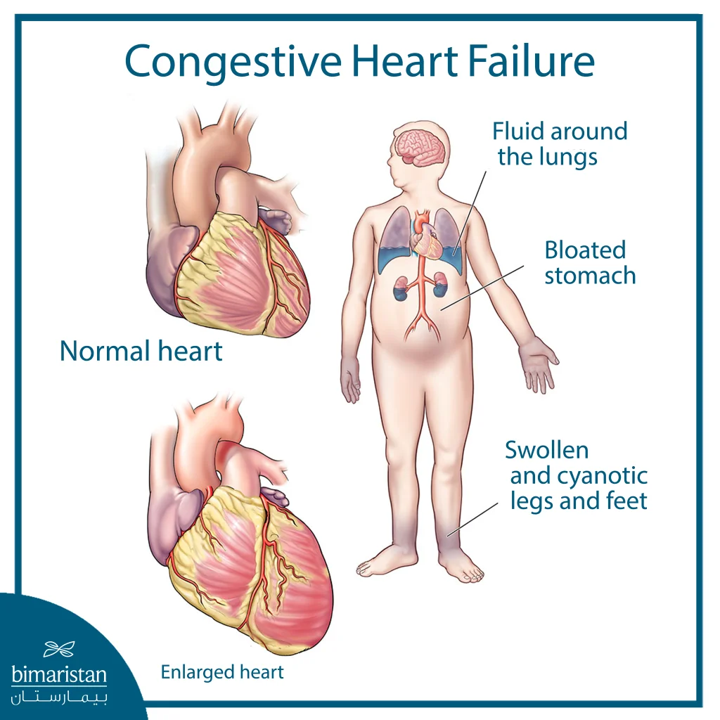 Illustration Showing The Effects Of Congestive Heart Failure On The Body, Comparing A Normal Heart With An Enlarged Heart And Showing Areas Of Fluid Retention