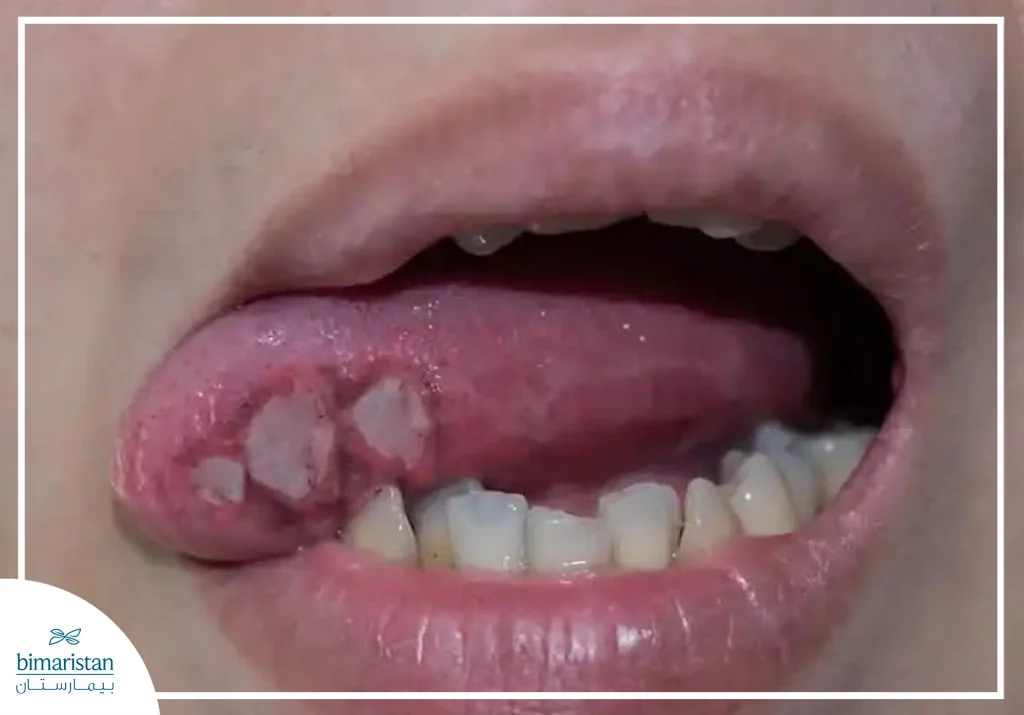 Image Of Tongue Cancer