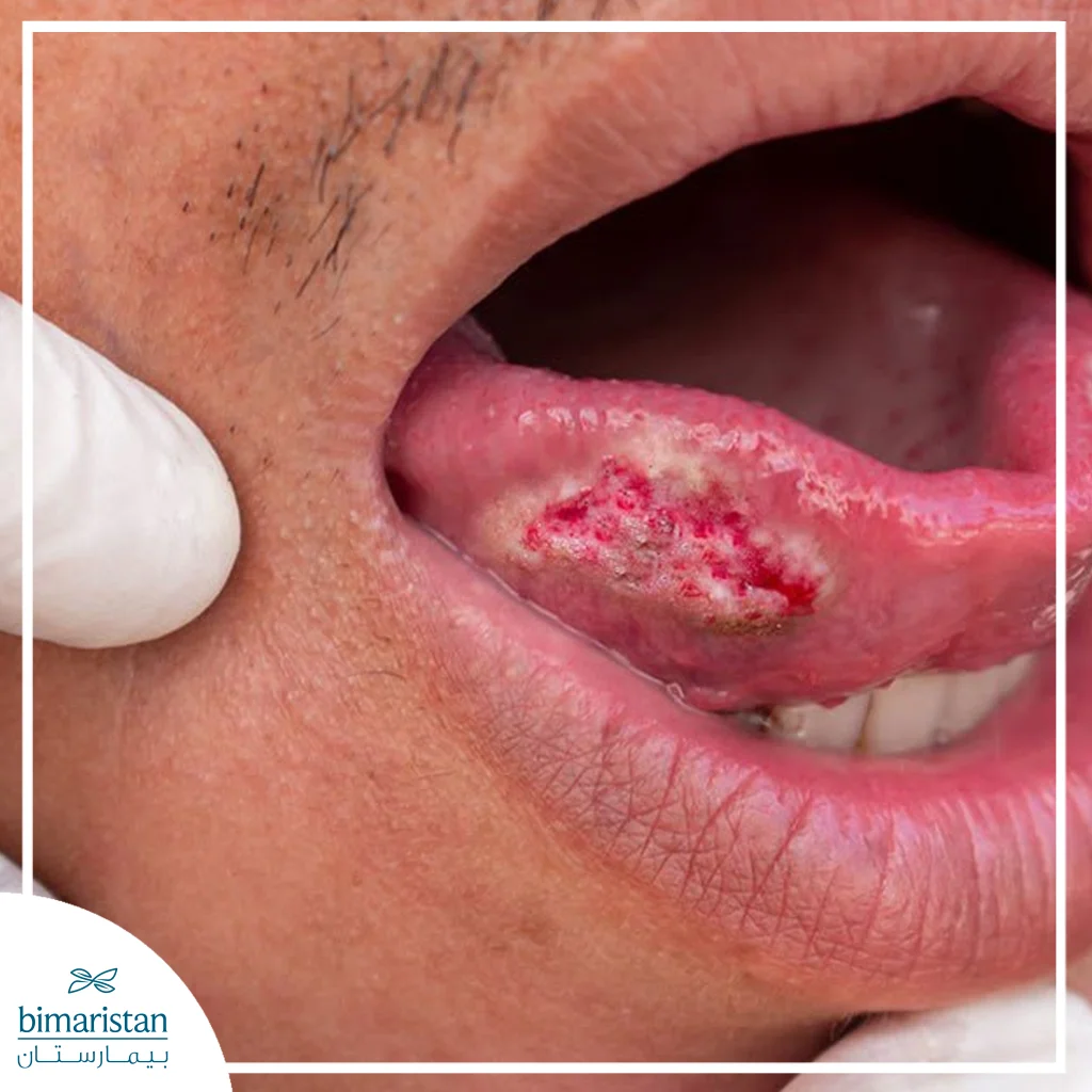 Image Of Tongue Cancer