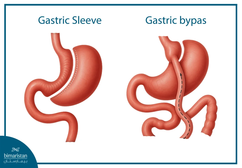 Image Showing Gastric Sleeve And Gastric Bypass