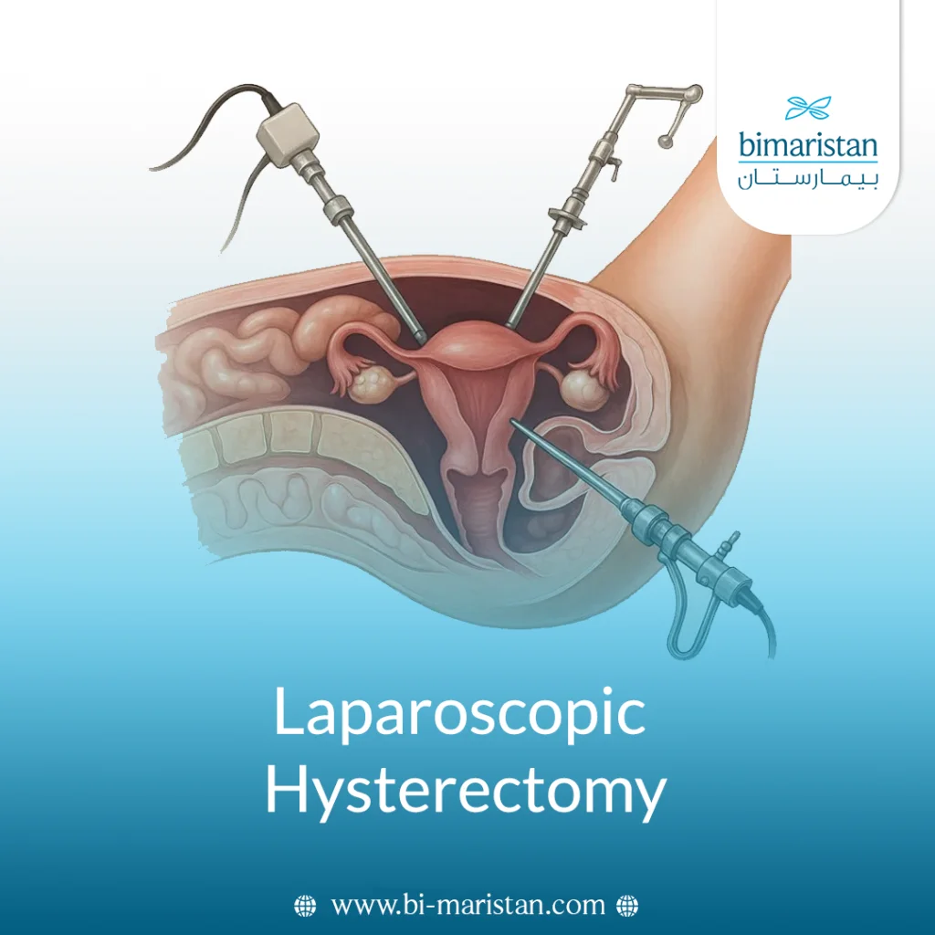 Laparoscopic Hysterectomy