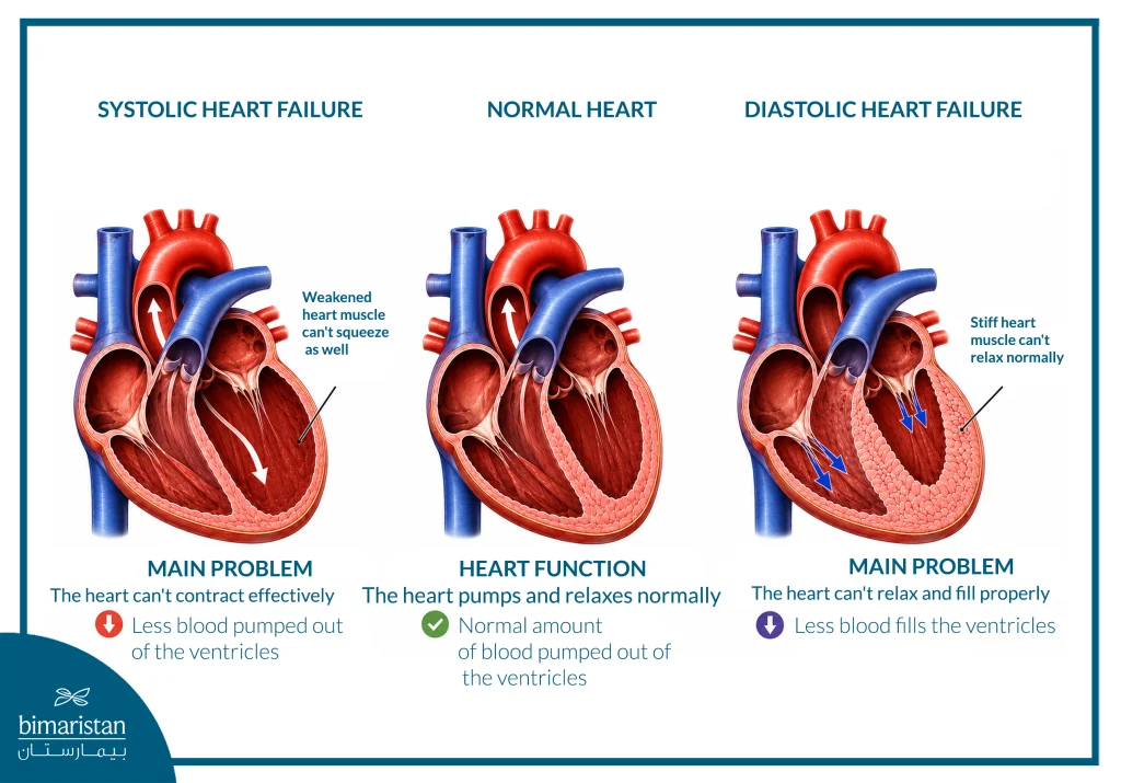Medical Illustration Comparing A Normal Heart With Systolic And Diastolic Heart Failure, Highlighting Differences In Heart Muscle Contraction And Left Ventricular Filling