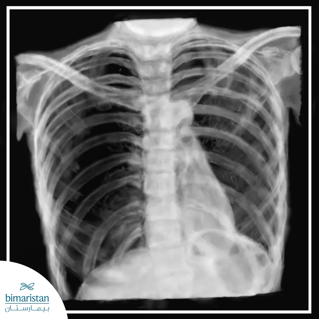 Radiograph Of A Pneumothorax