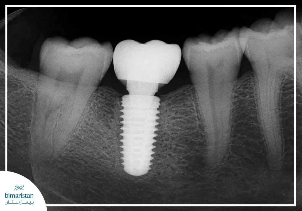 French Dental Implants: Features And Cost 2 Radiographic Image Showing Dental Implant Osseointegration With The Jawbone