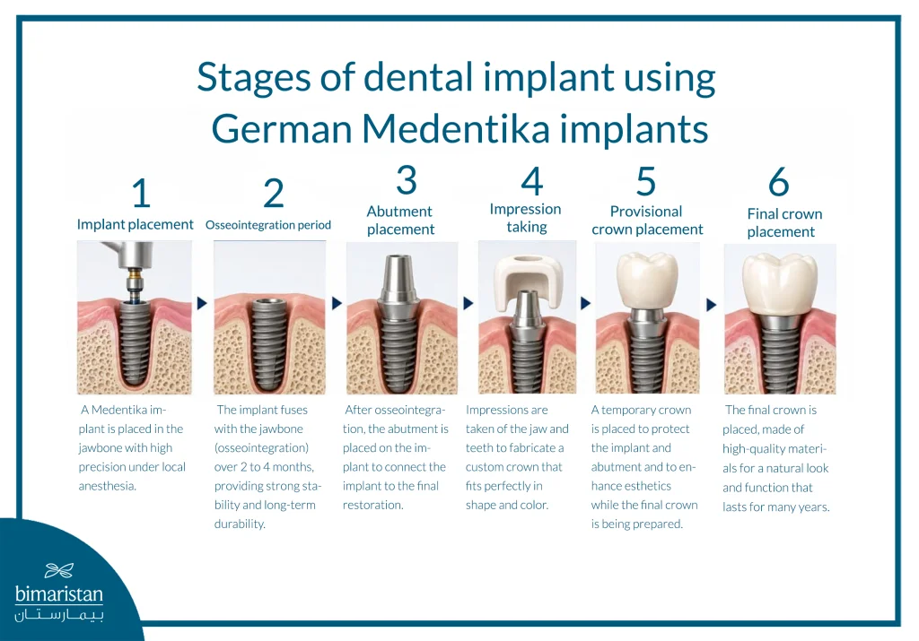 Stages Of Dental Implant Using German Medentika