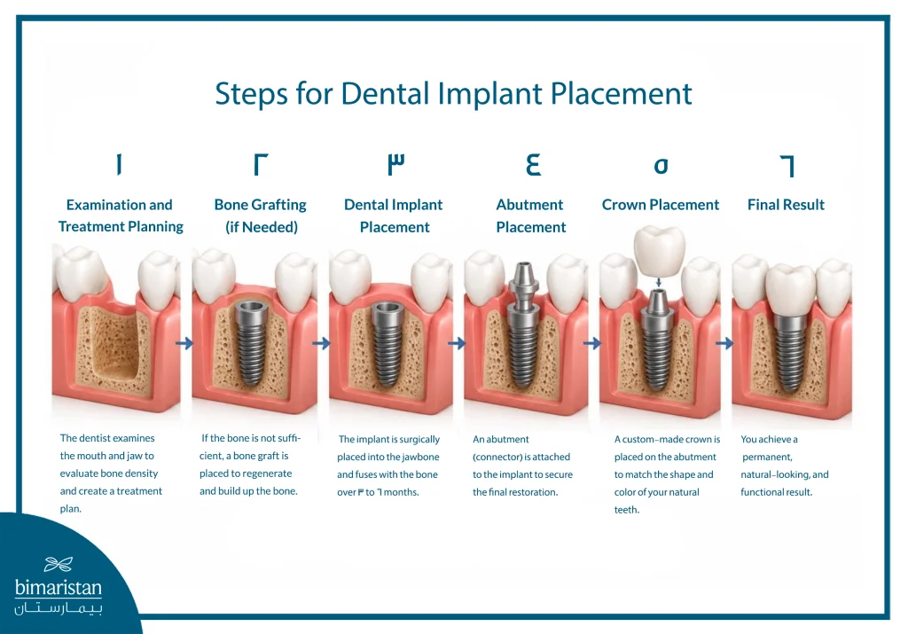 French Dental Implants: Features And Cost 3 Steps Of Dental Implant Surgery