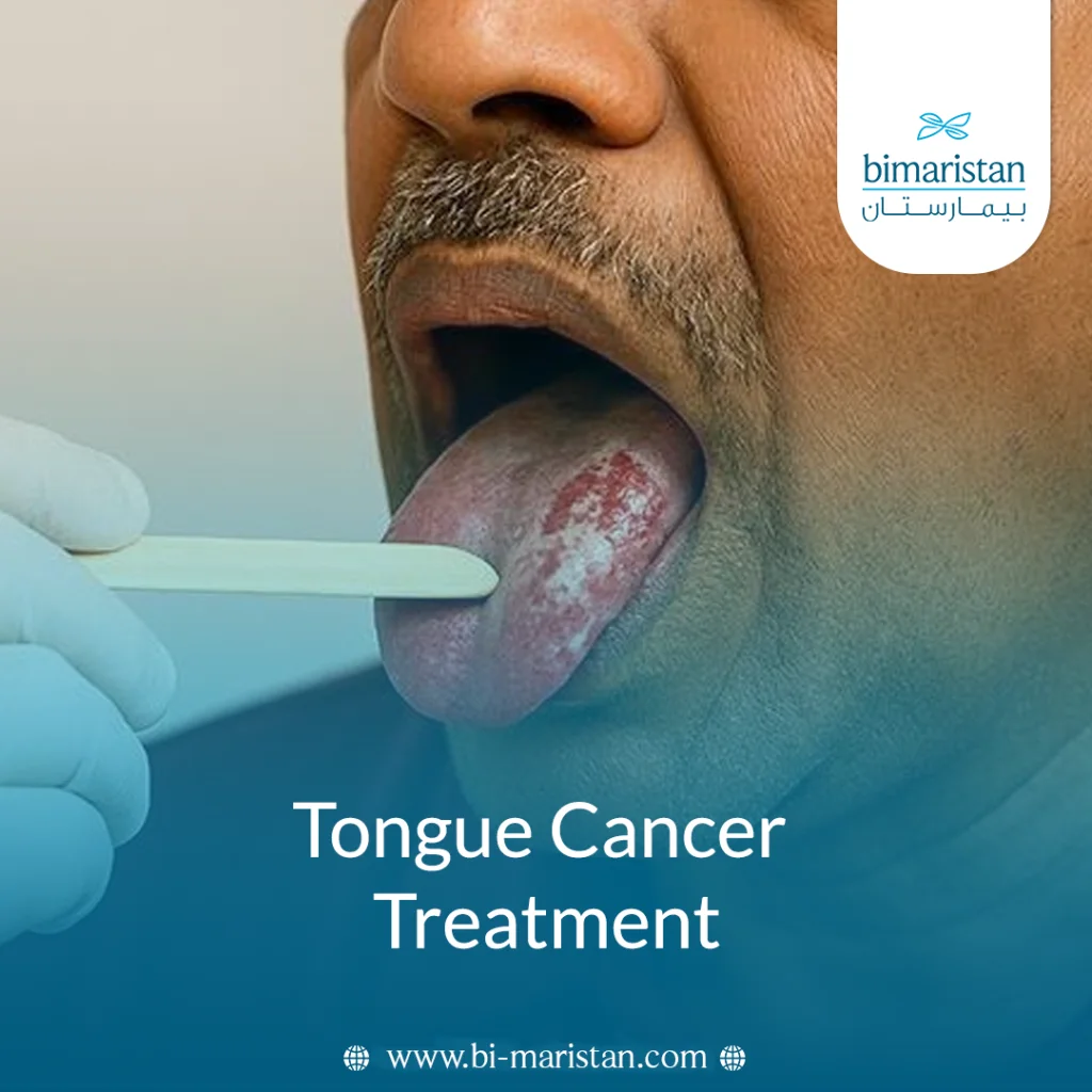 Tongue Cancer Treatment