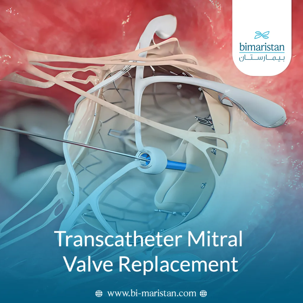 Transcatheter Mitral Valve Replacement (Tmvr)