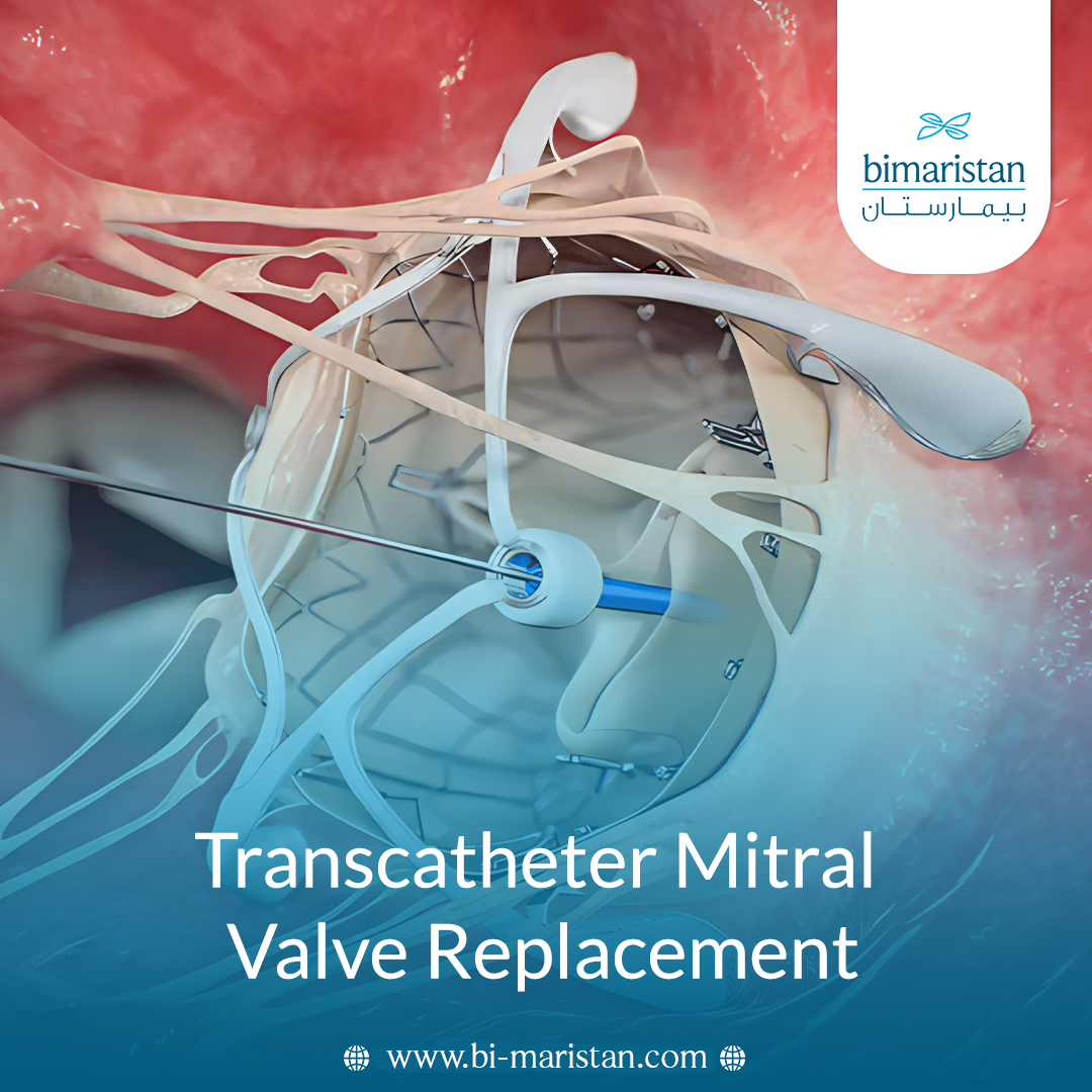 Transcatheter Mitral Valve Replacement (Tmvr): How Is It Performed, And When Is It An Appropriate Option?
