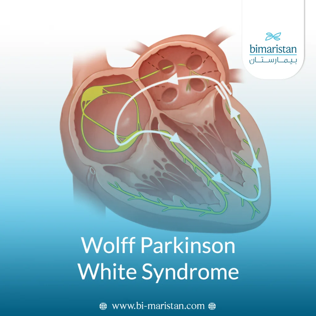 Wolff-Parkinson-White Syndrome