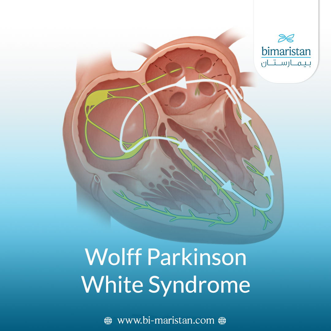 Wolff-Parkinson-White Syndrome: Causes, Signs, And Management