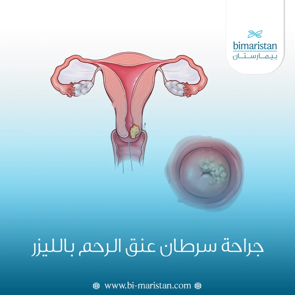 جراحة سرطان عنق الرحم بالليزر