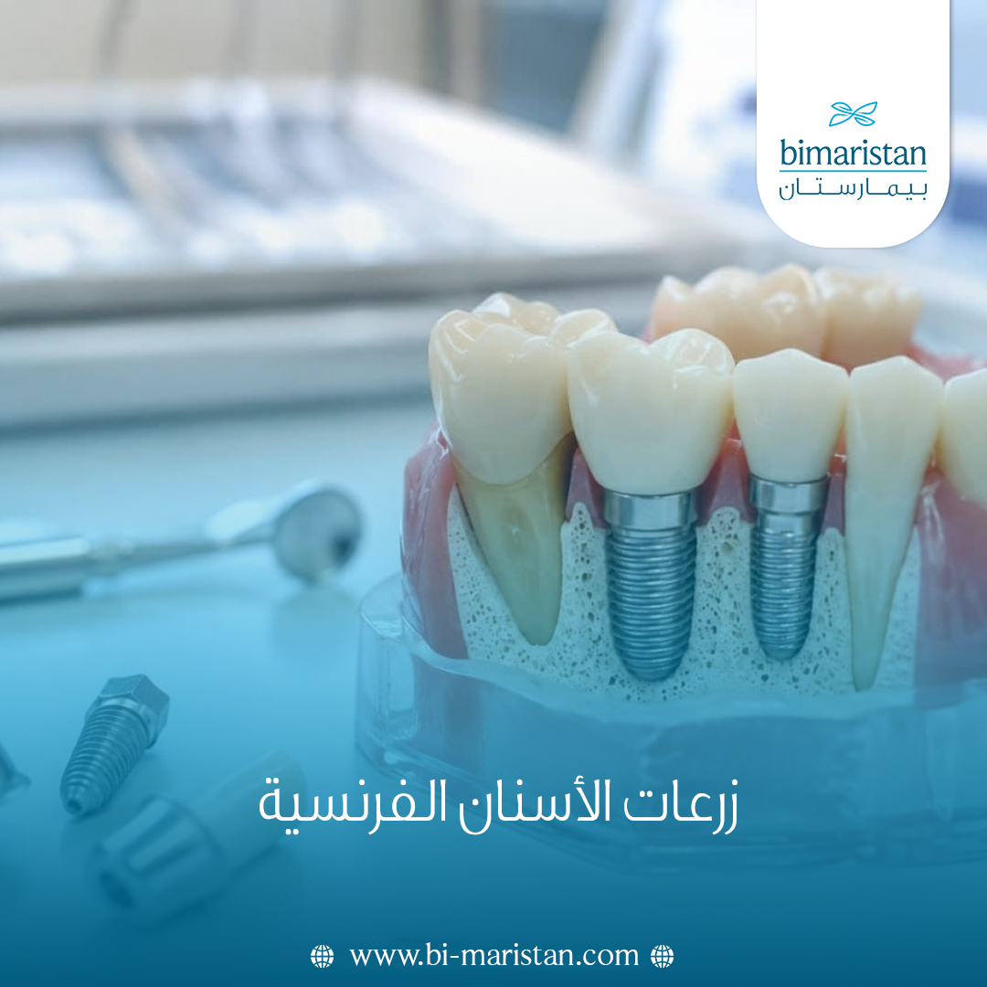 زرعات الأسنان الفرنسية