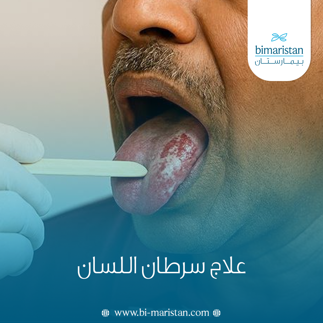 علاج سرطان اللسان