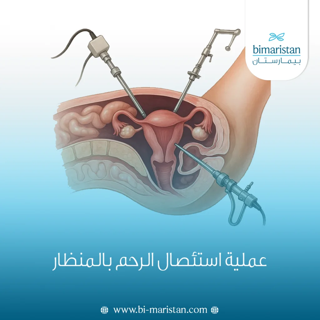عملية استئصال الرحم بالمنظار