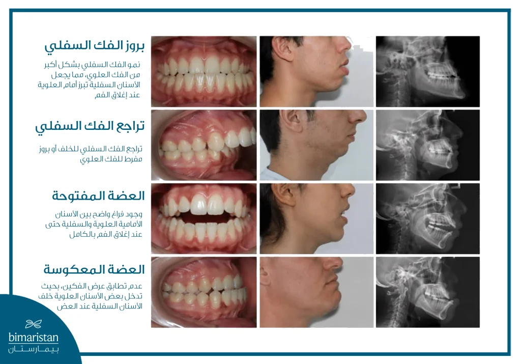 أبرز حالات سوء الإطباق وتشوهات الفك