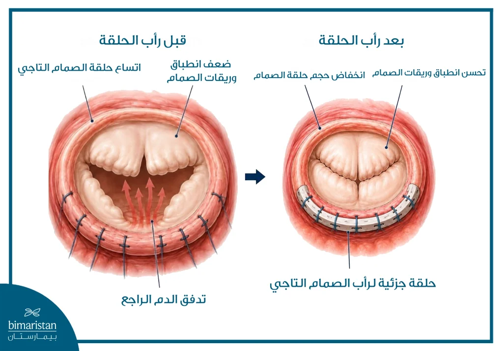صورة توضح الصمام التاجي قبل رأب الحلقة وبعده مع تحسن انطباق الوريقات وتقليل الارتجاع.