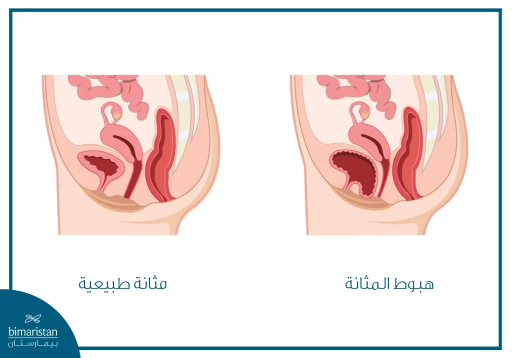 صورة توضح الفرق بين التوضع الطبيعي للمثانة وبين هبوط المثانة