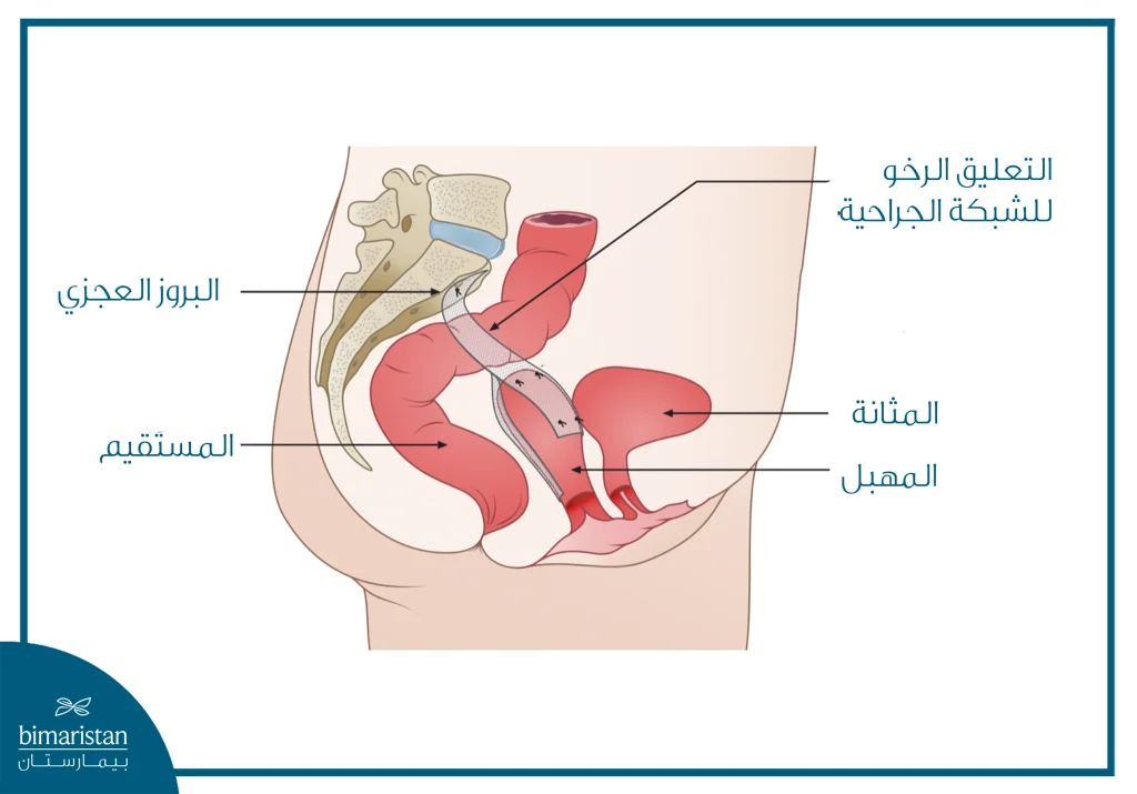 صورة توضح عملية عملية رفع المثانة عن طريق تثبيت المهبل إلى العجز باستخدام شبكة جراحية.