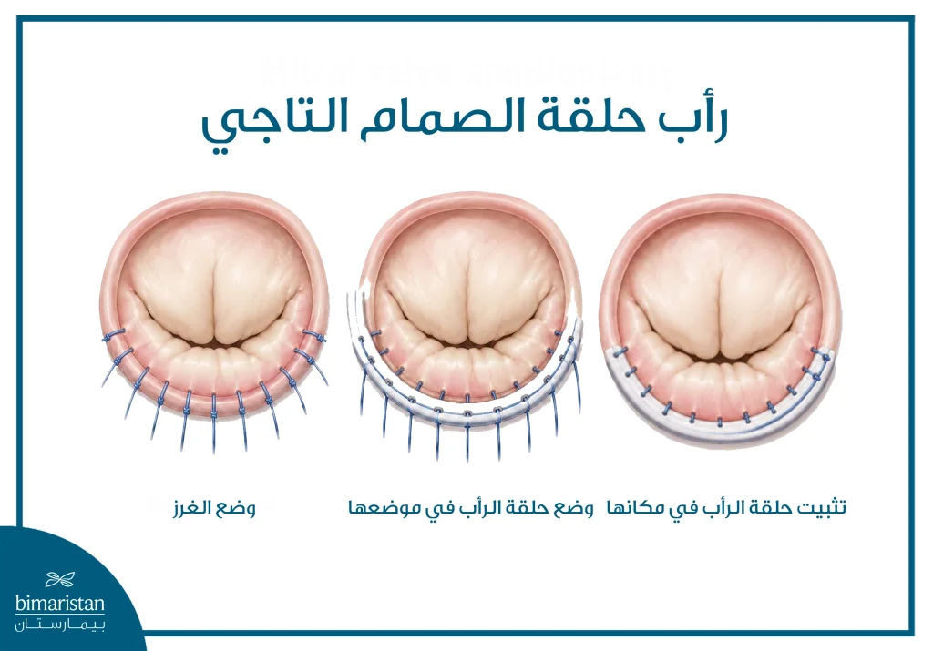 صورة توضح مراحل تثبيت حلقة رأب الصمام التاجي حول الصمام.