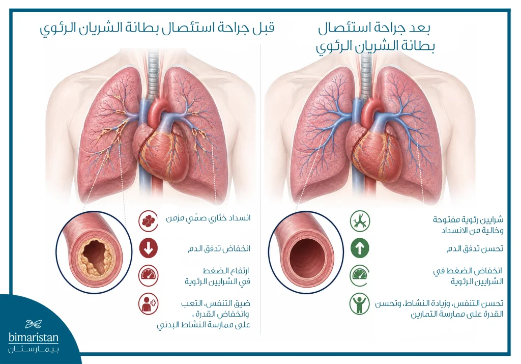 استئصال بطانة الشريان الرئوي (Pte): كيف تتم العملية وما نتائجها؟ 3 صورة مقارنة قبل وبعد استئصال بطانة الشريان الرئوي، تُظهر انسداد الشرايين الرئوية بالخثرات المزمنة قبل الجراحة وتحسن تدفق الدم بعد إزالة الانسداد.