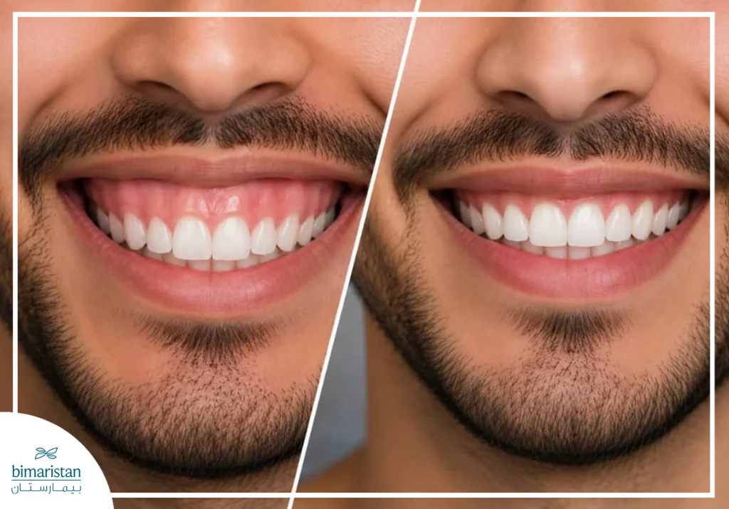 قبل وبعد علاج الابتسامة اللثوية