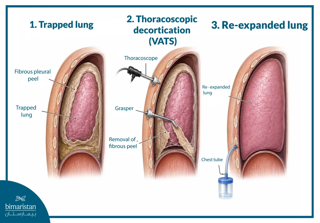 An Image Showing The Stages Of Thoracoscopic Lung Decortication (Vats), From A Trapped Lung Encased By A Fibrous Pleural Peel, Through Thoracoscopic Removal Of The Peel, To Lung Re-Expansion With Chest Tube Drainage