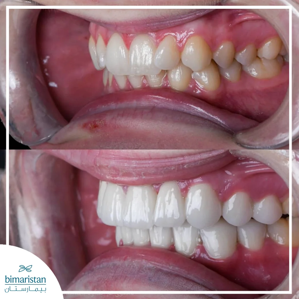 Before And After E-Max Veneers