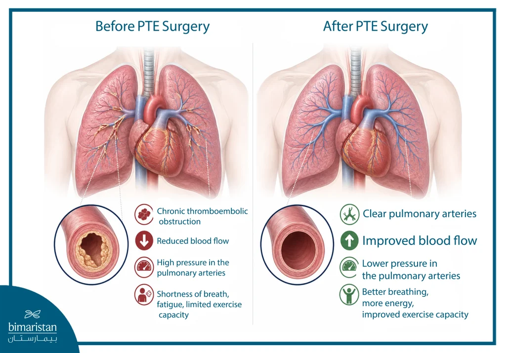 Before-And-After Illustration Of Pulmonary Thromboendarterectomy Showing Chronic Pulmonary Artery Obstruction Before Surgery And Improved Blood Flow After Clot Removal.