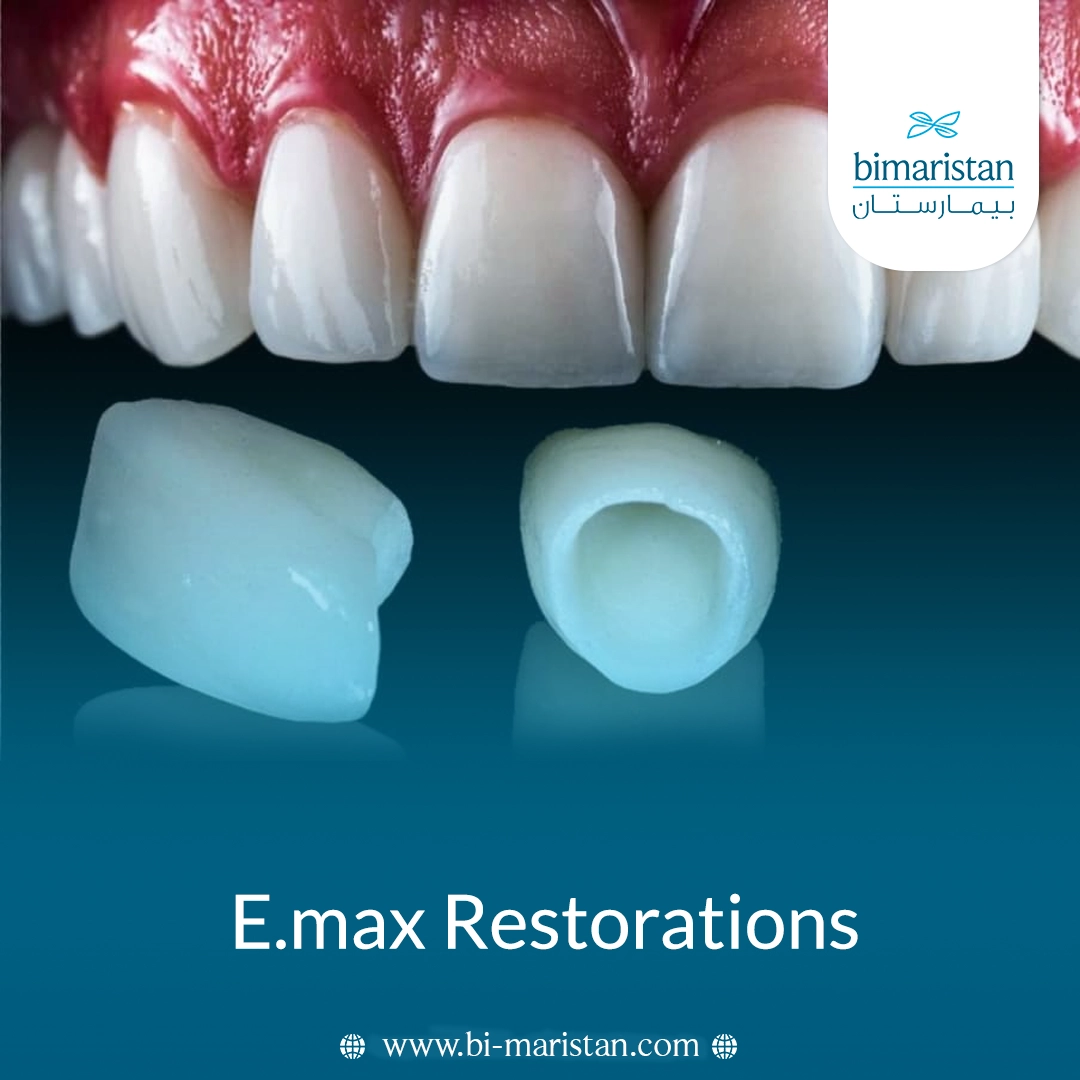 E.max Restorations