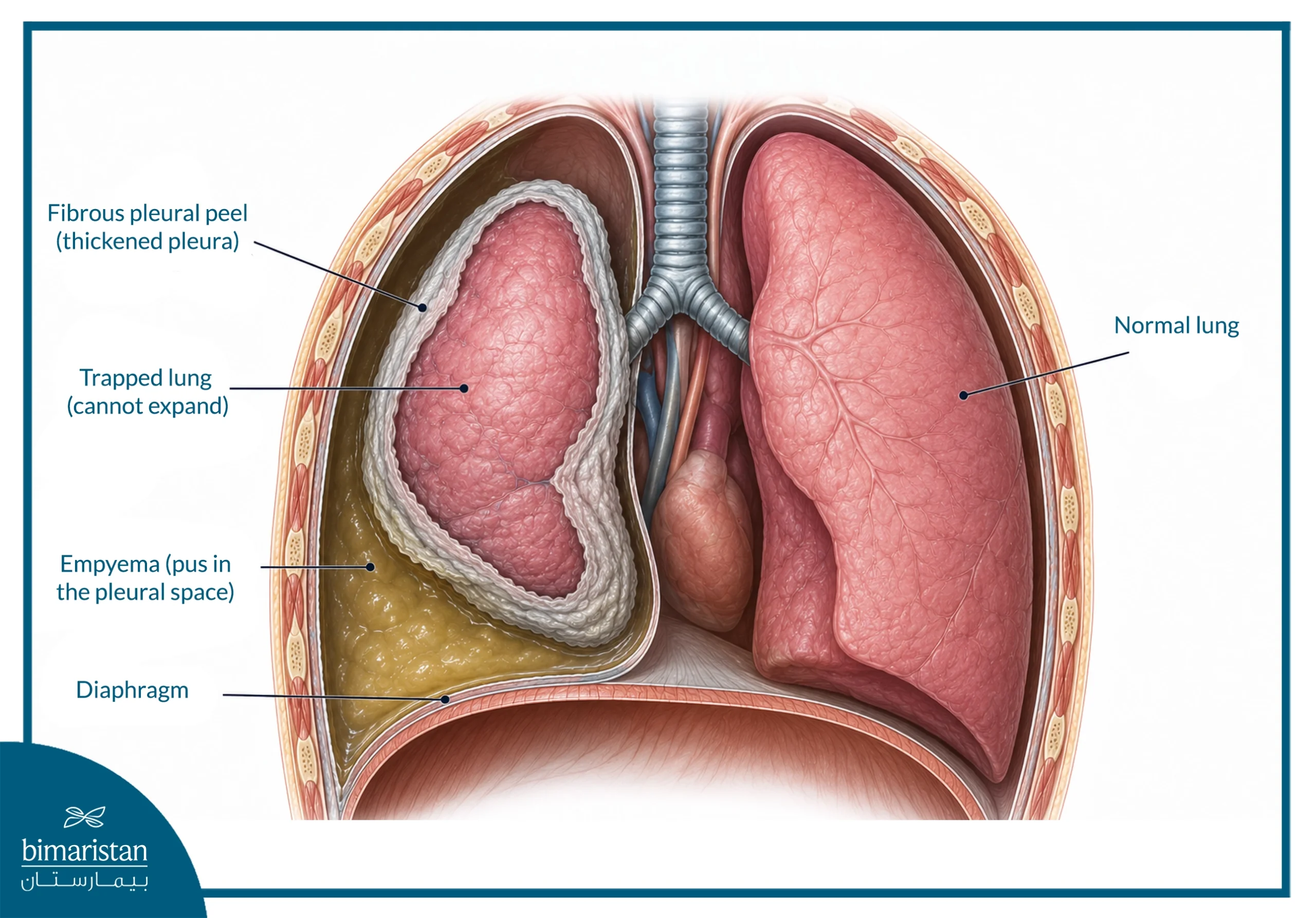 An Illustration Of Empyema And Trapped Lung, Showing Pus Accumulation In The Pleural Space And A Thick Fibrous Pleural Peel Restricting Lung Expansion, Compared With A Normal Lung
