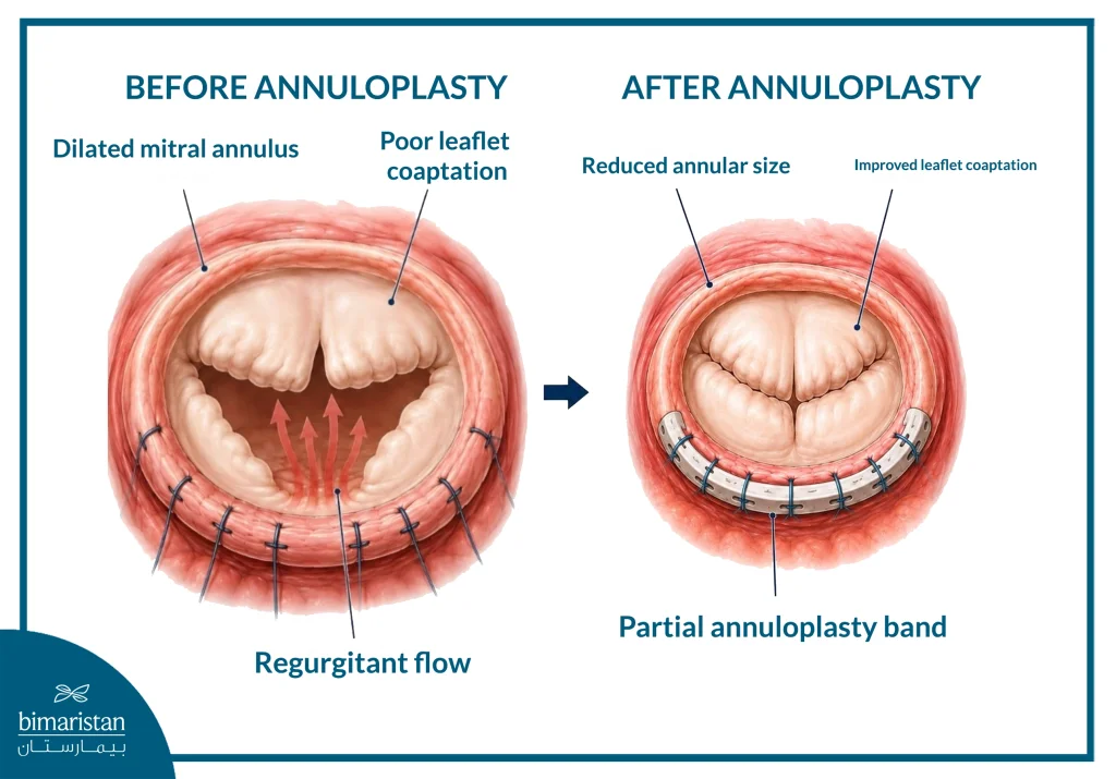 Illustration Of The Mitral Valve Before And After Annuloplasty, Showing Improved Leaflet Coaptation And Reduced Regurgitation