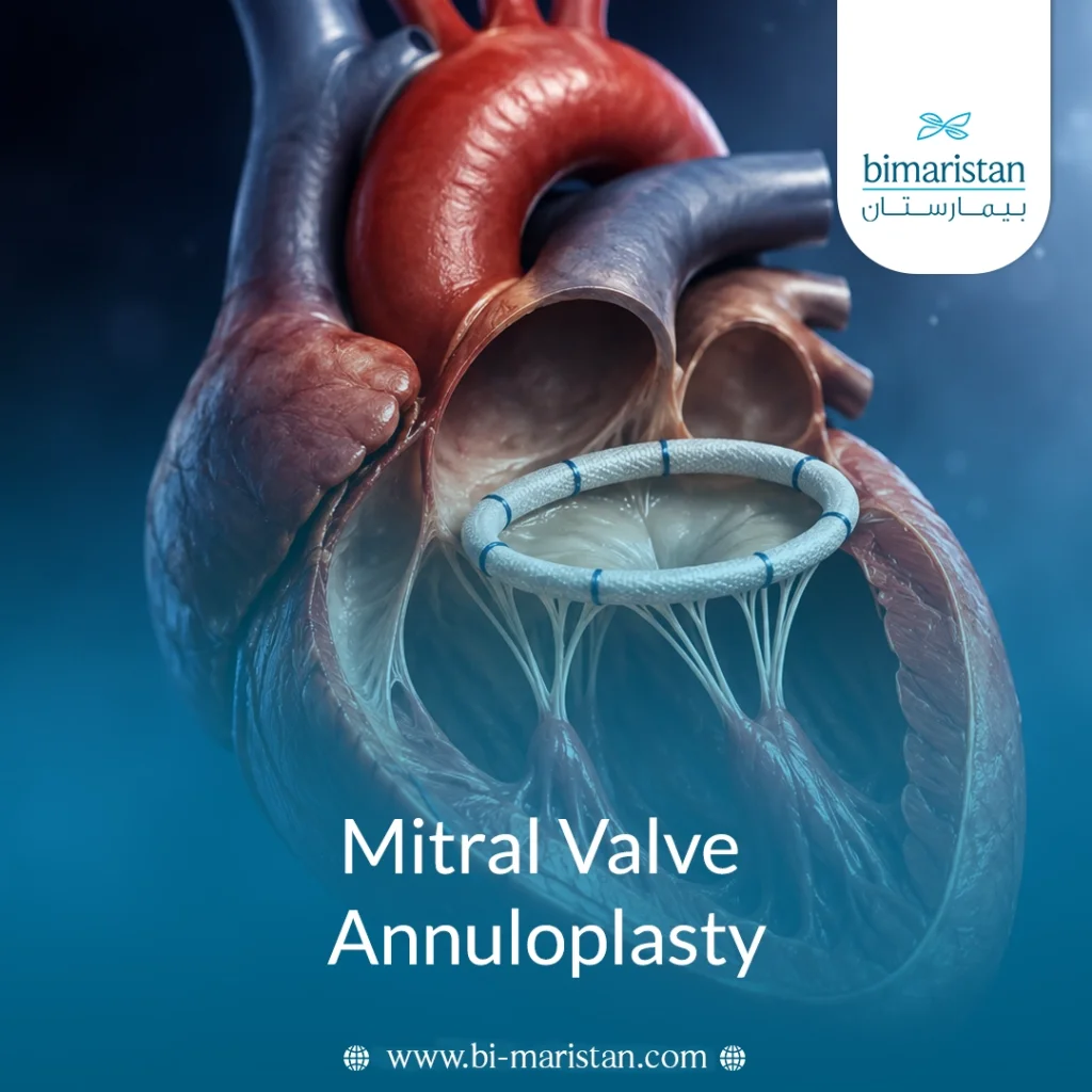 Mitral Valve Annuloplasty