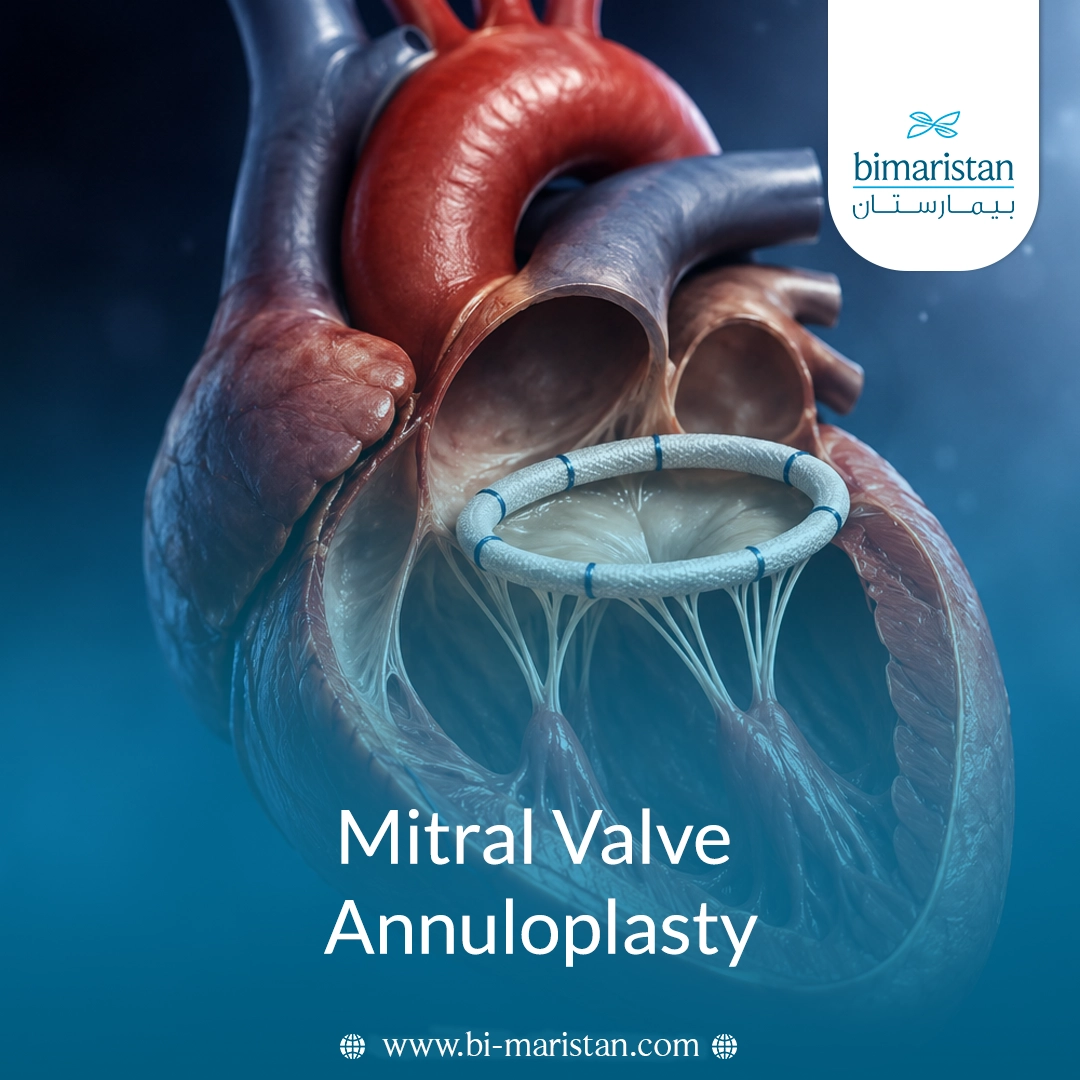 Mitral Valve Annuloplasty: Understanding The Procedure And Its Benefits