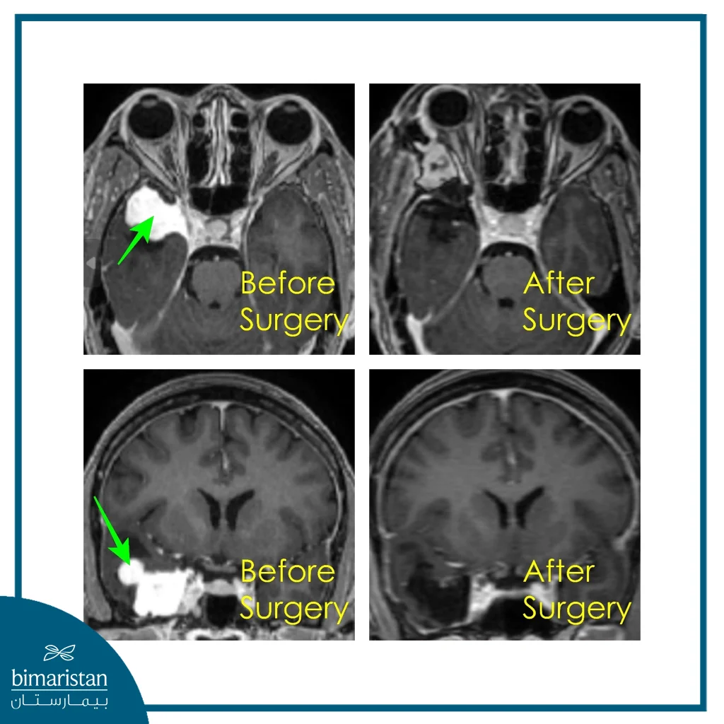 Comparative Pre- And Post-Operative Mri Scans Of A Transorbital Neurosurgery Show A Large Lesion Near The Orbit And Skull Base Prior To Surgery, Followed By Its Regression After Surgical Resection