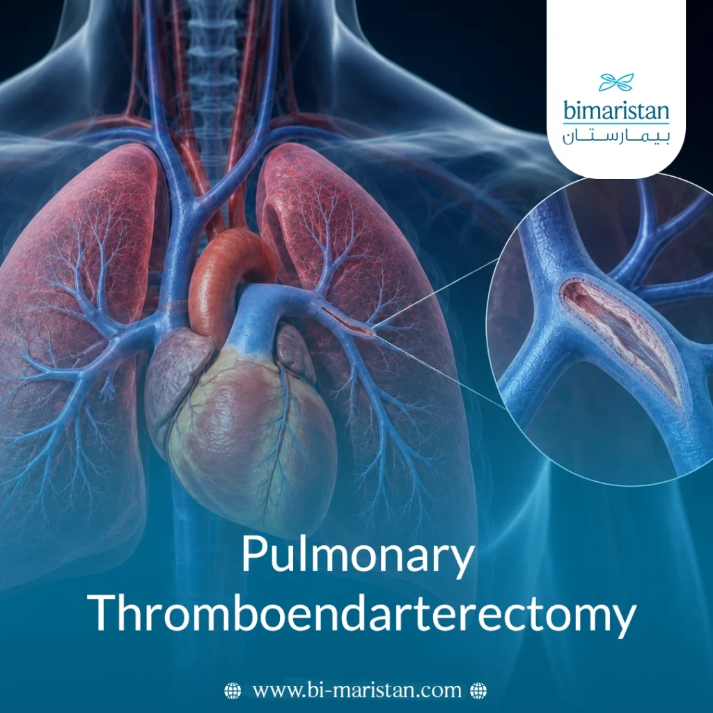 Pulmonary Thromboendarterectomy