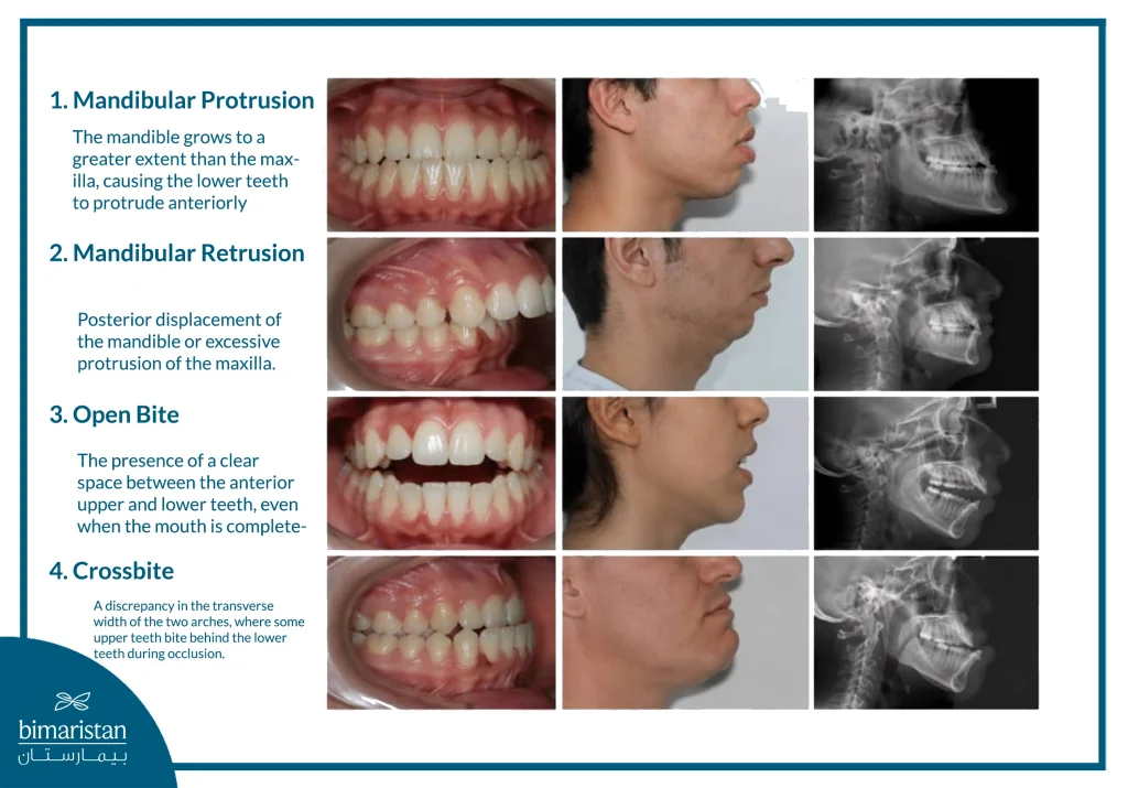 The Most Common Cases Of Malocclusion And Jaw Deformities